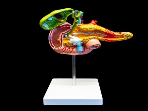 Colorful model showing the pathology of the pancreas, duodenum, and gallblader attached to a stand